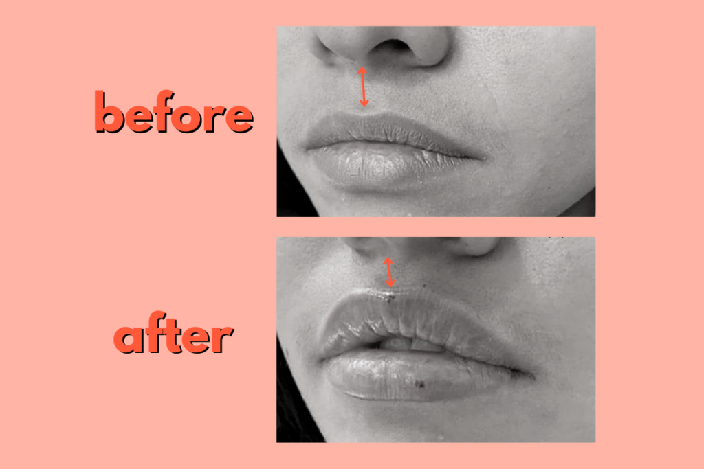before and after of botox lip flip procedure
