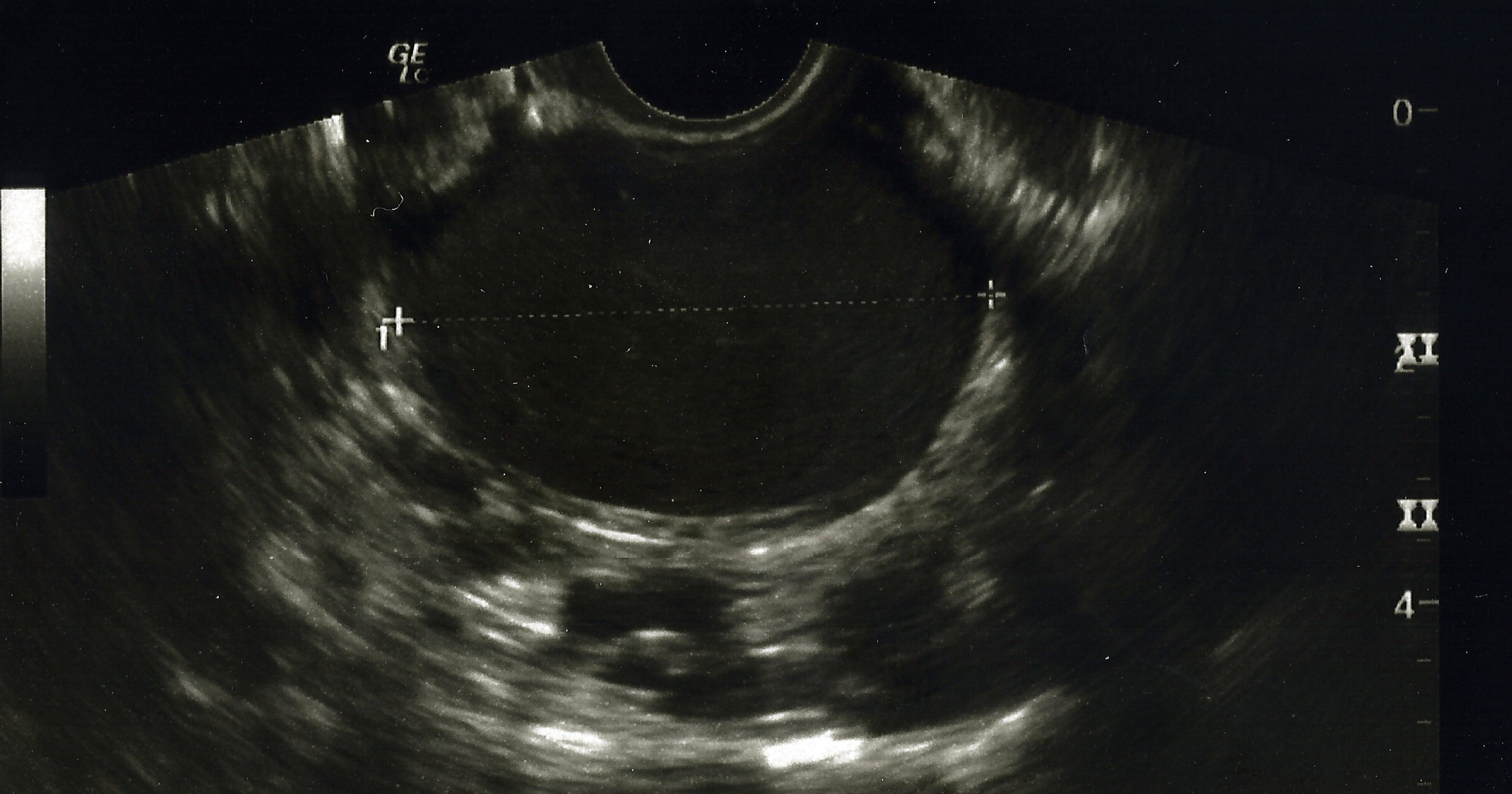 An American Endometriosis Test Is Available in England. Not Here.
