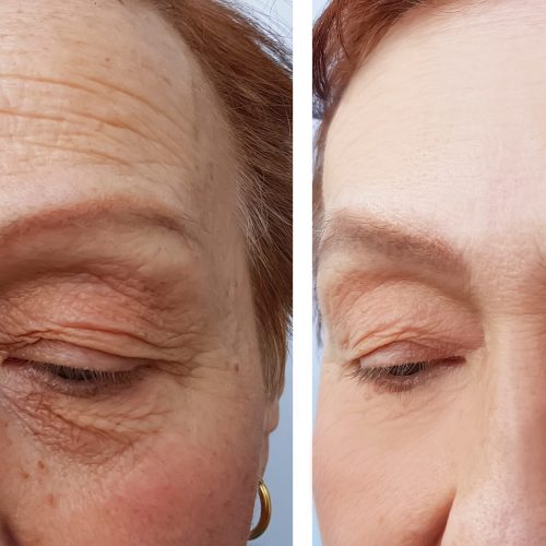 Before and after photos of older woman who had botulism toxin treatment